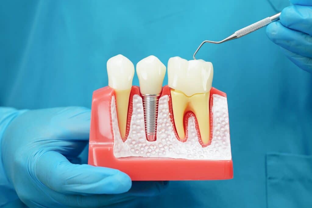 Dental Implants McLean